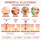 Everlasting 6 in 1 Multi-function Blackhead Remover